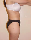 Liposuction 1029782