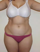 Liposuction before 1029782