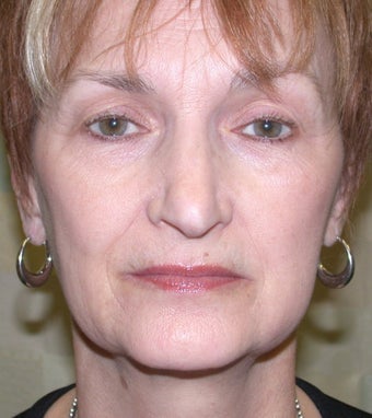 Facelift before 611273