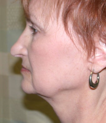 Facelift 611273