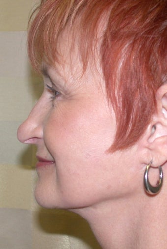 Facelift 611273