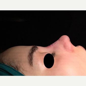 25-34 year old woman treated with Rhinoplasty after 3211781