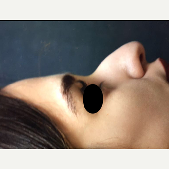 25-34 year old woman treated with Rhinoplasty before 3211781