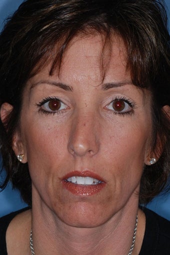 Rhinoplasty before 81098