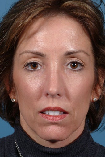 Rhinoplasty after 81098