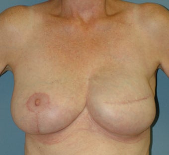 Breast Reconstruction 665426