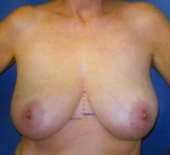 Breast Reconstruction before 665426