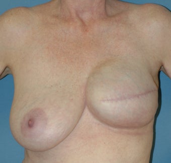 Breast Reconstruction after 665426