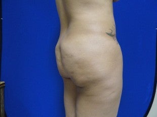 38 year old Brazilian Butt Lift before 1069863
