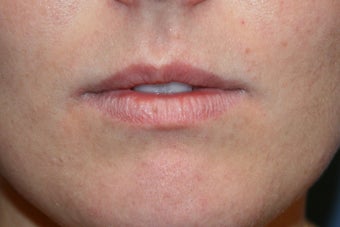 Lip augmentation with Juvederm before 91251