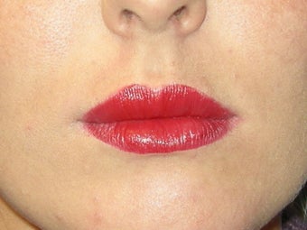 Lip augmentation with Juvederm after 91251