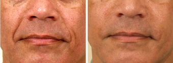 Juvederm after 325528