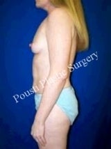 Extra Large Breast Augmentation, Silicone gel Implants 1257100