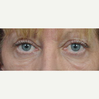 55-64 year old woman treated with Eyelid Surgery before 3453866