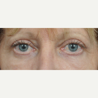 55-64 year old woman treated with Eyelid Surgery after 3453866
