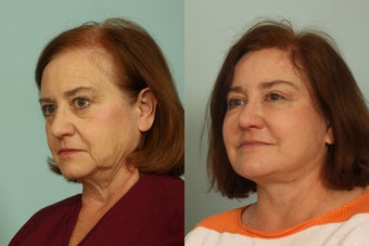 Hair Transplantation after 993586