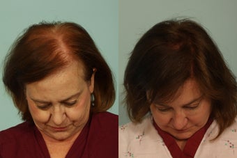 Hair Transplantation before 993586
