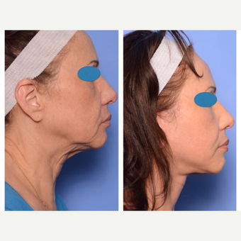 55-64 year old woman treated with Deep plane (HGH SMAS) Facelift after 3715346