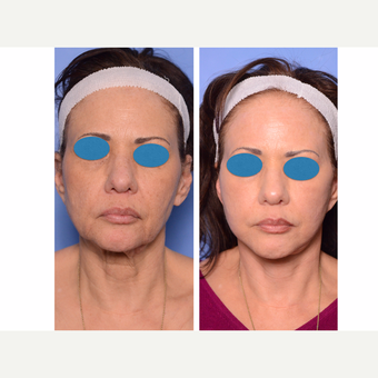 55-64 year old woman treated with Deep plane (HGH SMAS) Facelift before 3715346