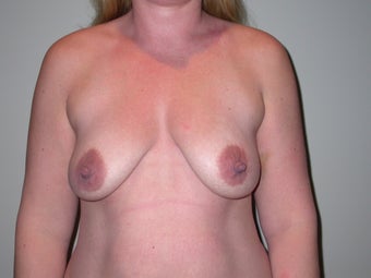 Breast lift, abdominoplasty, liposuction before 273304