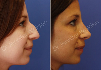 Septorhinoplasty before 1112651