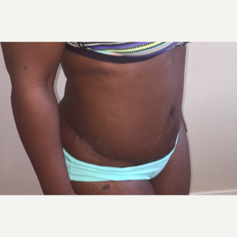 38 year old woman treated with Tummy Tuck after 3582276