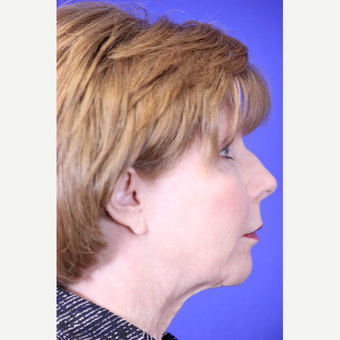 59 year old woman treated with Neck Lift before 3419677