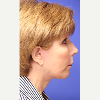 59 year old woman treated with Neck Lift after 3419677