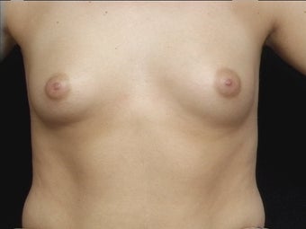 26 Year Old For Breast Augmentation before 1173223