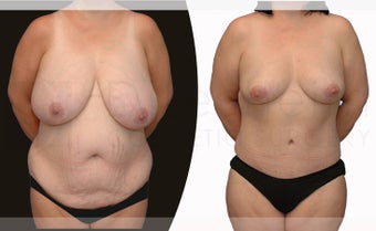 38 year old woman Tummy Tuck, Breast Reduction and Liposuction before 1127679