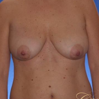 41 yr old has an Anchor Breast Lift with Implants before 3501277