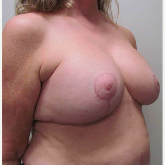 Breast Lift with Implants for this 58 Year Old Woman after 3043303