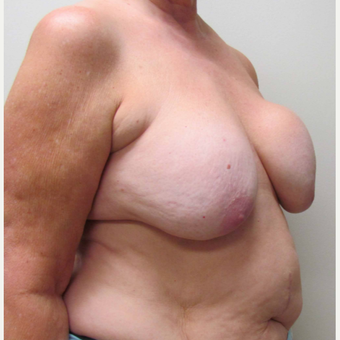 Breast Lift with Implants for this 58 Year Old Woman before 3043303