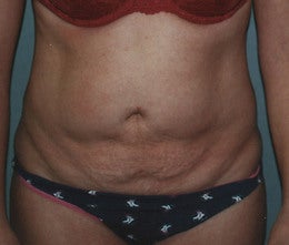 44-Year Old Female Tummy Tuck before 665096