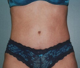 44-Year Old Female Tummy Tuck after 665096