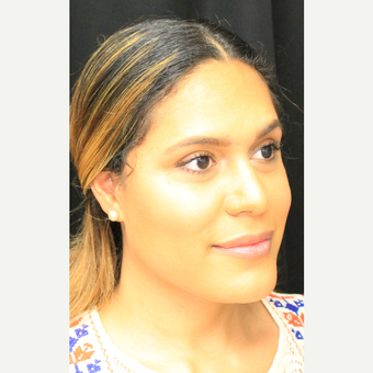 35-44 year old woman treated with Brow Lift before 3741743