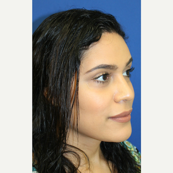 35-44 year old woman treated with Brow Lift after 3741743