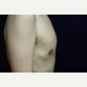 31 year old man treated for gynecomastia with liposuction after 3419144