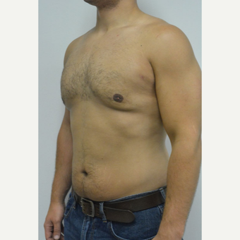 25-34 year old man treated with Male Breast Reduction after 3070580