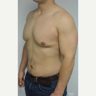 25-34 year old man treated with Male Breast Reduction before 3070580