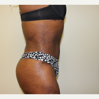 Tummy Tuck after 3417706