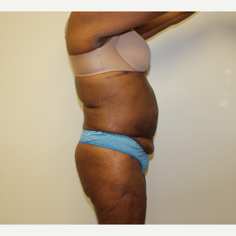 Tummy Tuck before 3417706
