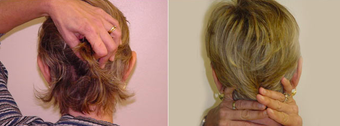 Otoplasty before 1012844