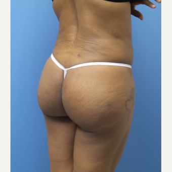45-54 year old woman treated with Brazilian Butt Lift after 3377289