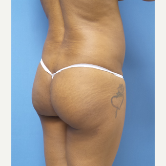 45-54 year old woman treated with Brazilian Butt Lift before 3377289