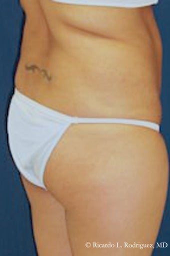 Brazilian Butt Lift before 635100