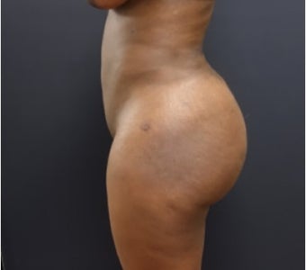 35-44 year old woman treated with Brazilian Butt Lift after 3200903