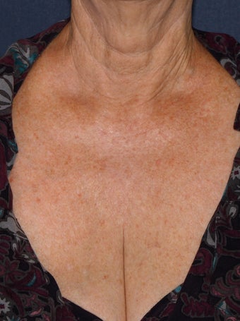 66 year old female chest treated with Fraxel Repair for wrinkles, texture, sun damage after 1131435
