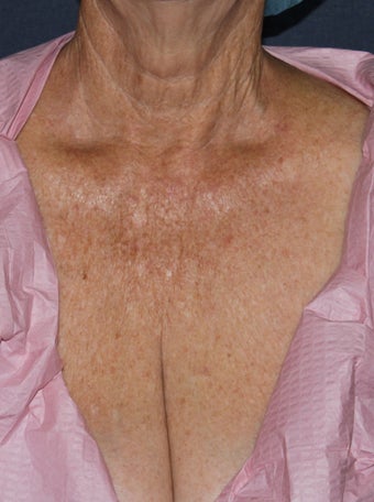 66 year old female chest treated with Fraxel Repair for wrinkles, texture, sun damage before 1131435
