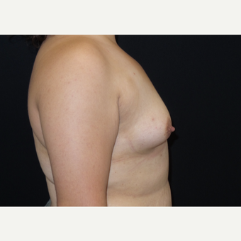 25-34 year old woman treated with Breast Augmentation before 3182014